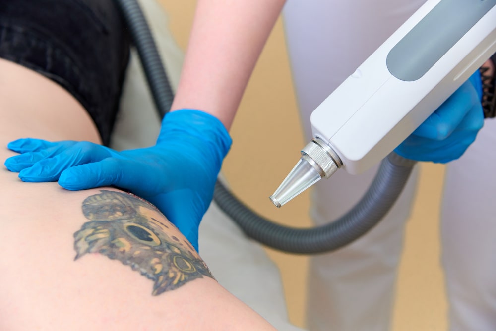 Patient undergoing laser tattoo removal procedure at Revive Skin and Cosmetology Clinic