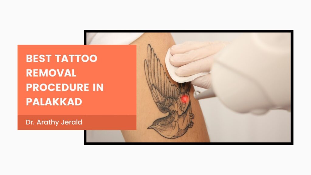 Laser tattoo removal procedure at Dr. Arathy's Revive Skin and Cosmetology Clinic in Palakkad