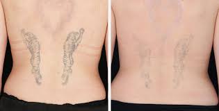 Advanced laser tattoo removal equipment at Revive Skin and Cosmetology Clinic