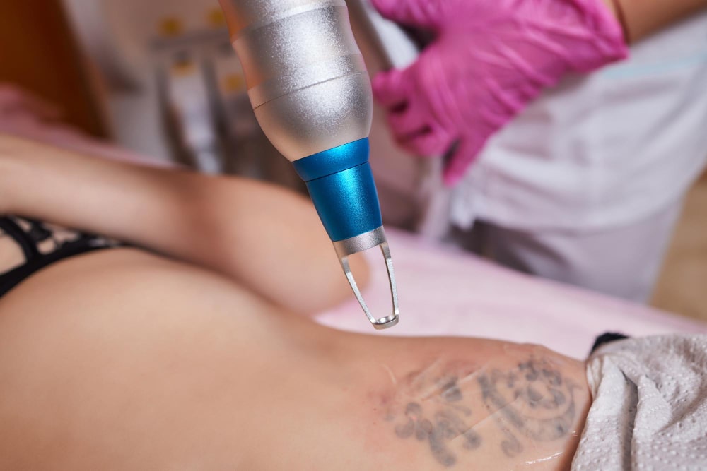 Before and After Laser Tattoo Removal