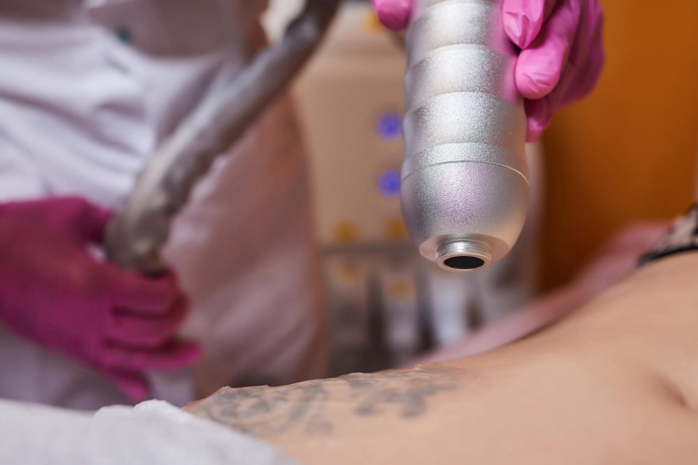 State-of-the-Art Laser Tattoo Removal Equipment