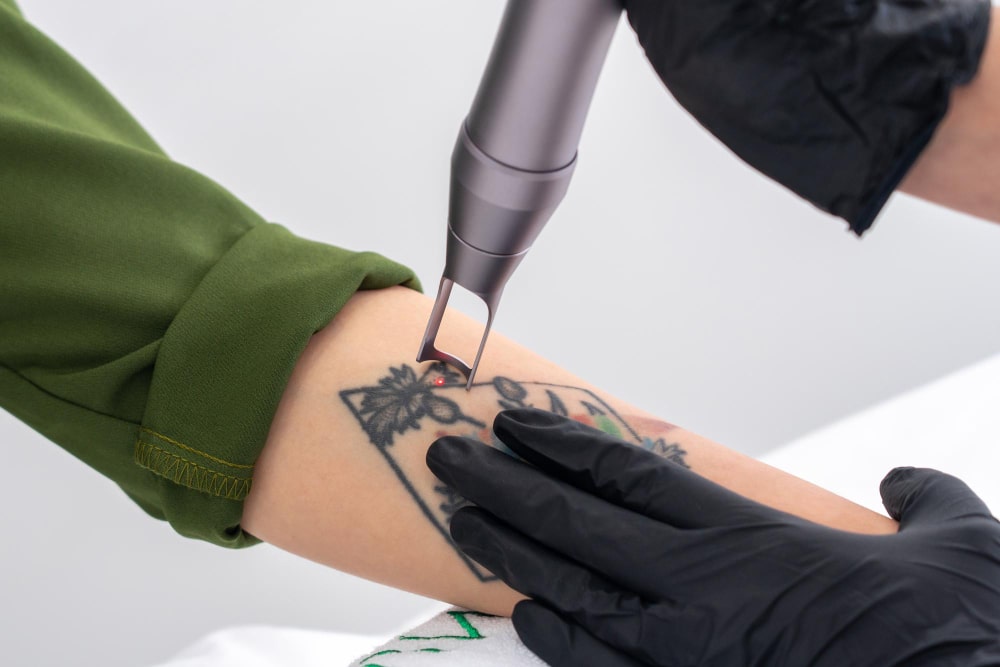 Dr. Arathy's Laser Tattoo Removal Consultation