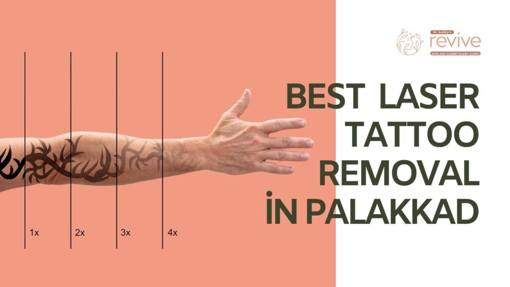 Laser Tattoo Removal Process