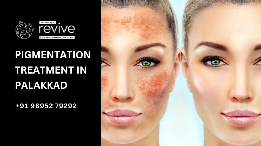 Pigmentation Treatment in Palakkad at Dr. Arathy's Revive Skin and Cosmetology Clinic, featuring advanced skincare solutions for clear, radiant skin.