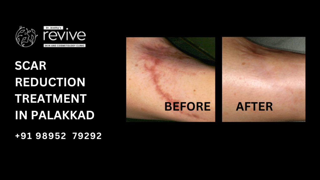 Revive Skin & Cosmetology Clinic in Palakkad offering advanced scar reduction treatments by Dr. Arathy Jerald. The clinic specializes in acne scars, surgical scars, and more using cutting-edge technology.