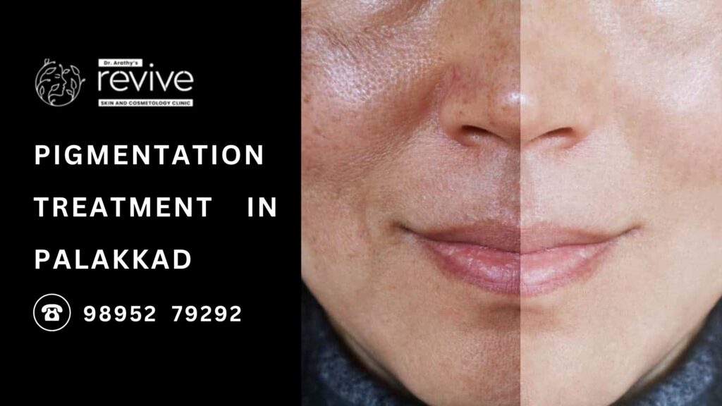 Pigmentation treatment in Palakkad at Revive Skin & Cosmetology Clinic for clear and radiant skin.