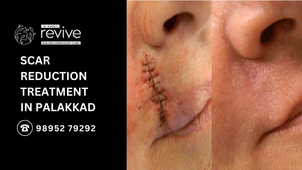 Scar reduction treatment at Revive Skin & Cosmetology Clinic, Palakkad – advanced skincare solutions for smooth and healthy skin.