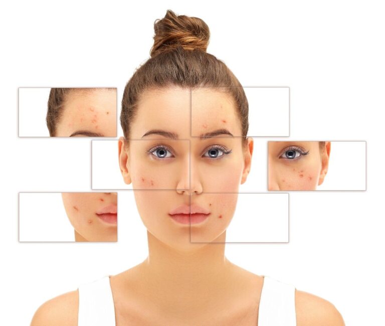 Different types of acne scars on facial skin including ice pick, boxcar, and rolling scars