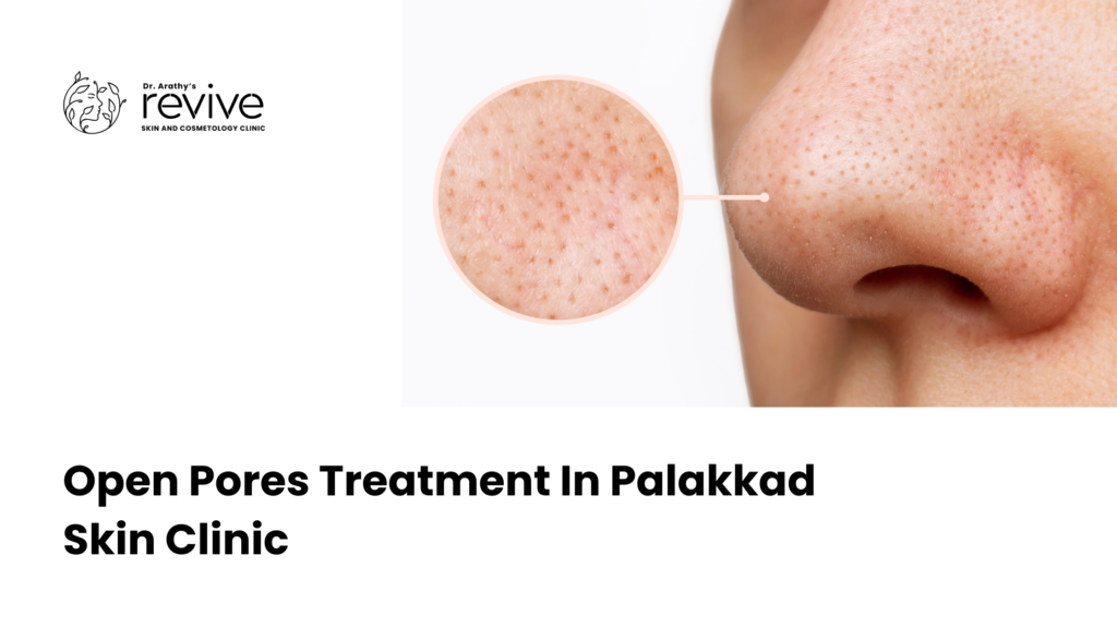 open pores treatment in Palakkad skin clinic
