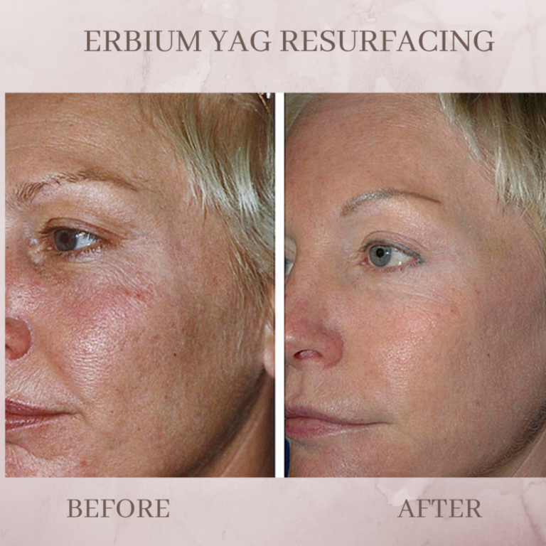 best laser treatment for acne scars in Palakkad