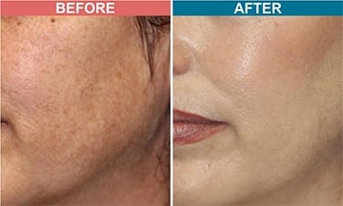 Laser Toning & Pigment-Specific Lasers