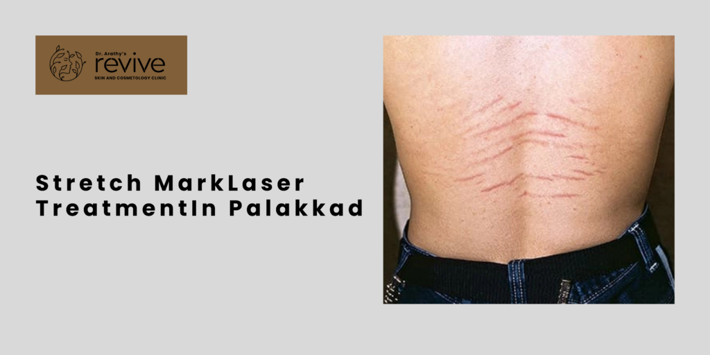stretch mark laser treatment in Palakkad