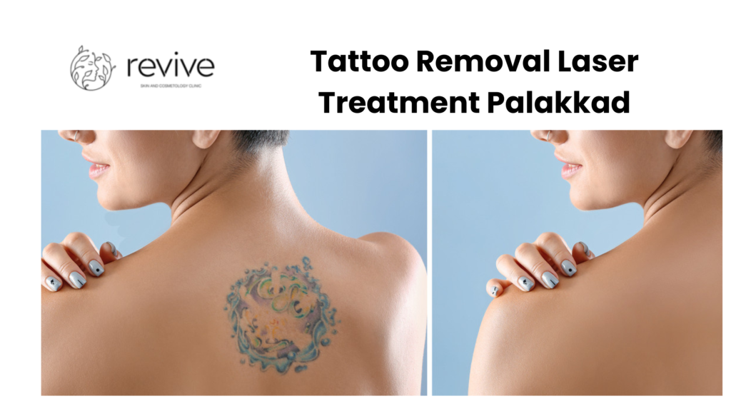 Tattoo Removal Laser Treatment Palakkad