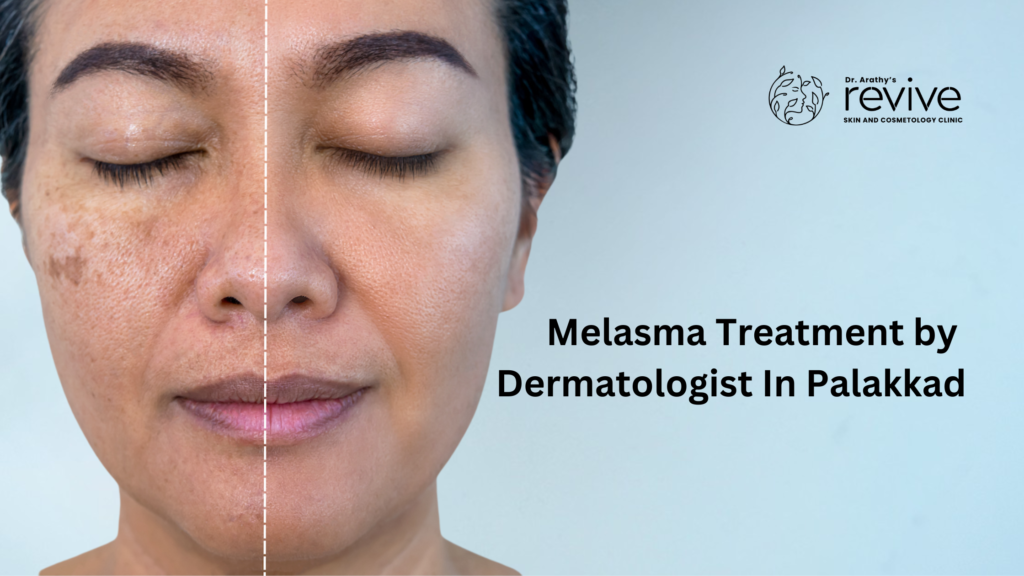 Patient receiving melasma treatment by dermatologist in Palakkad using advanced dermatologic techniques at Revive Clinic.