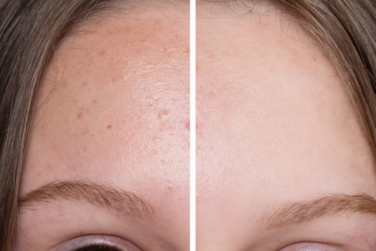 Fractional CO₂ Laser Resurfacing