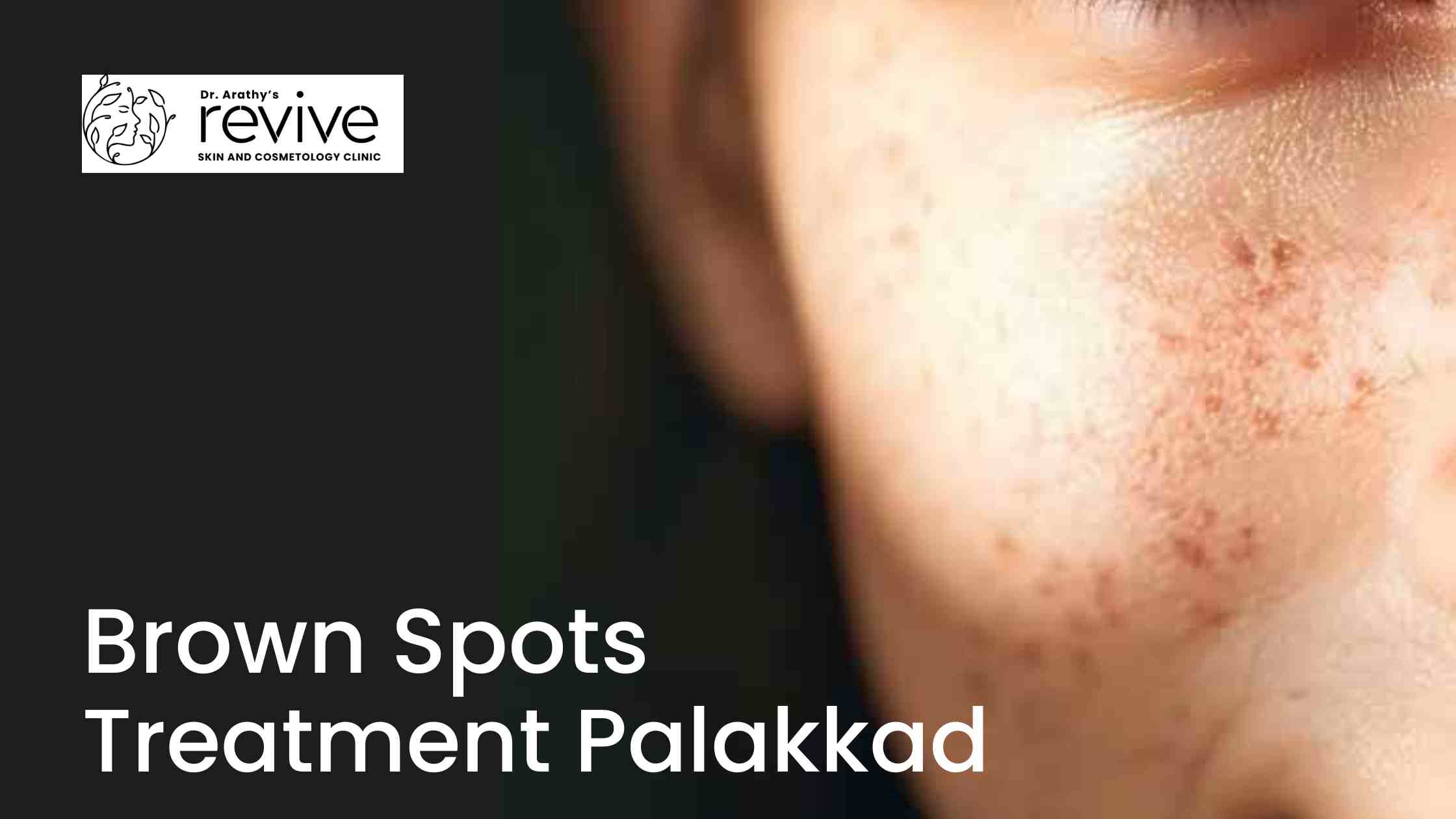 brown spots treatment Palakkad