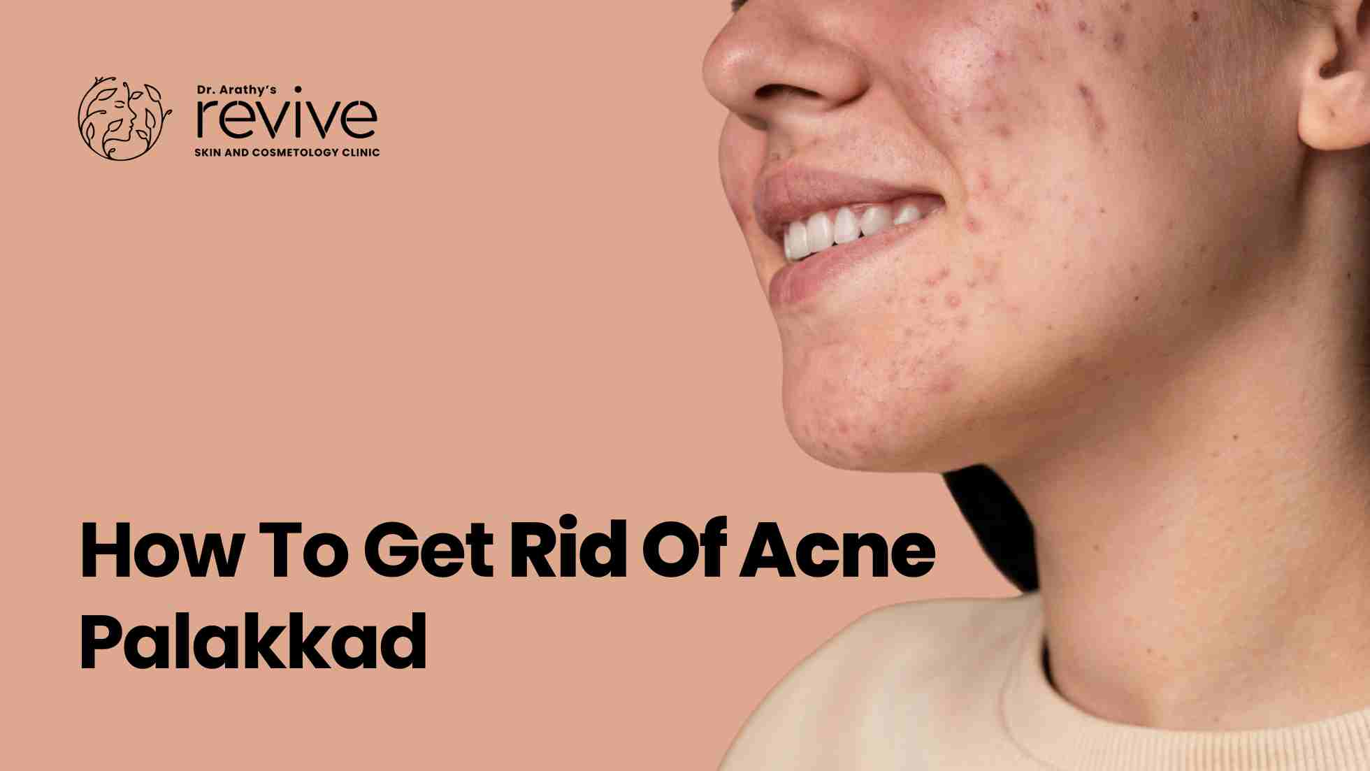 How To Get Rid Of Acne Palakkad