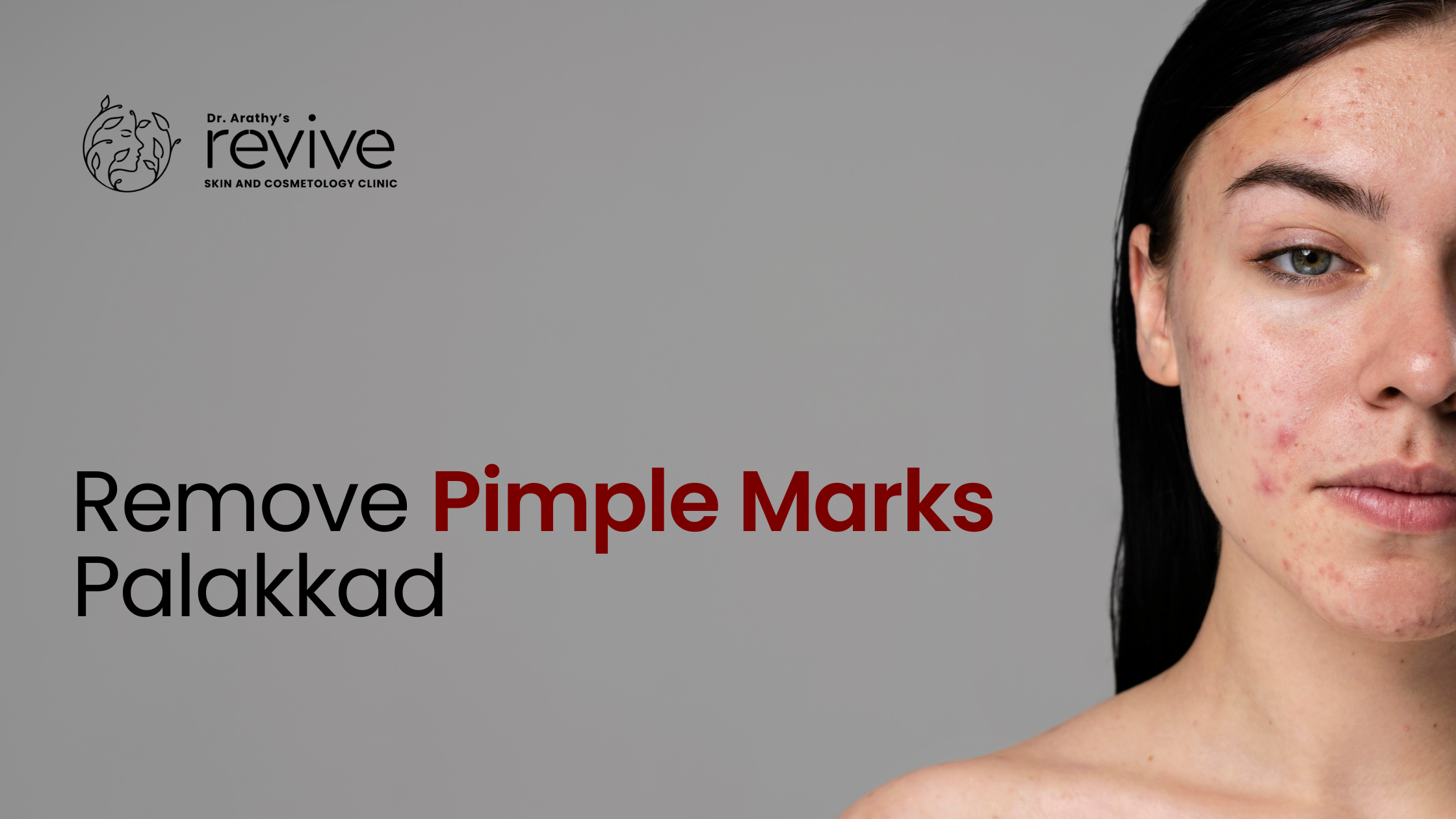 remove pimple marks Palakkad