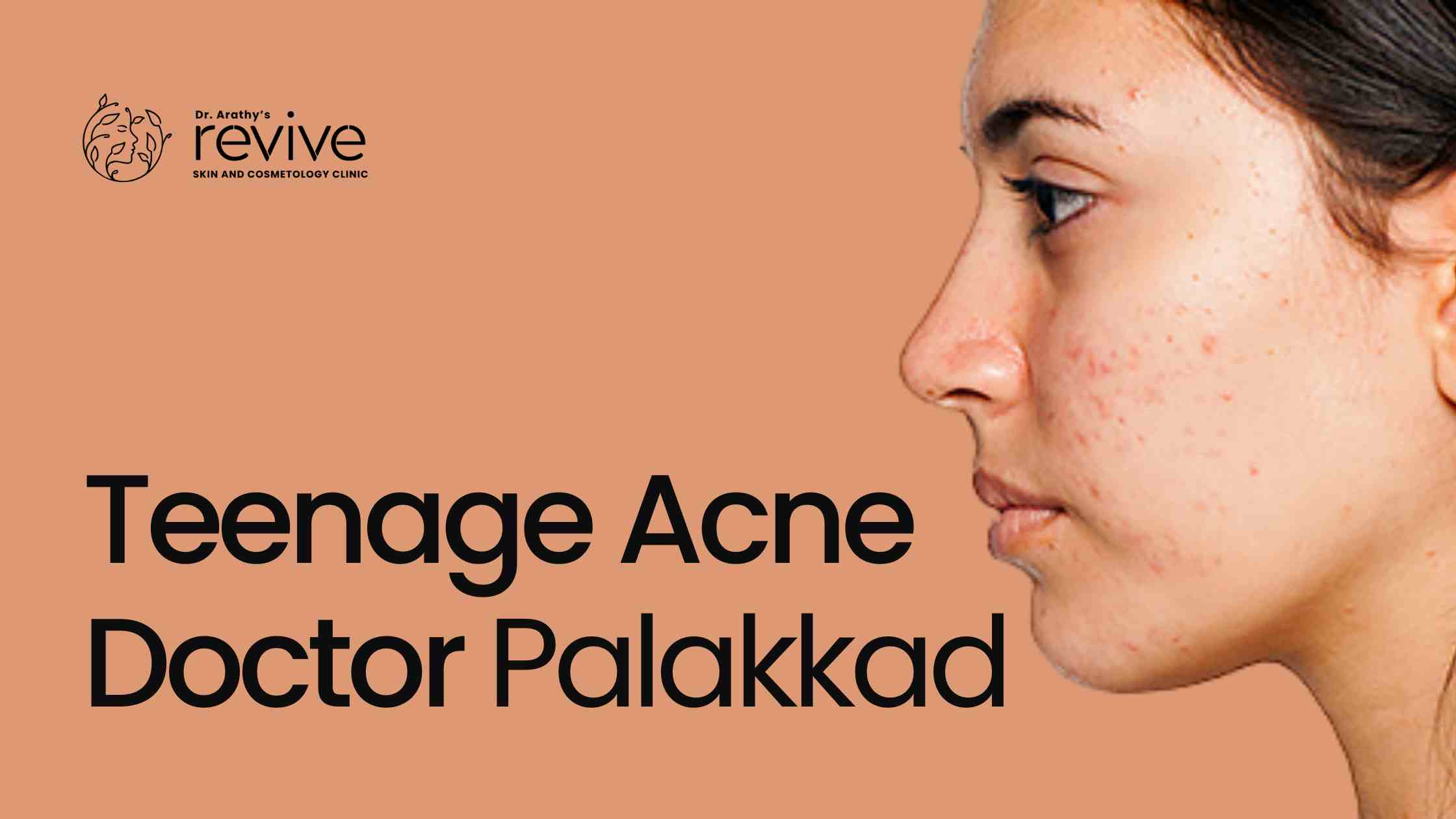 teenage acne doctor Palakkad