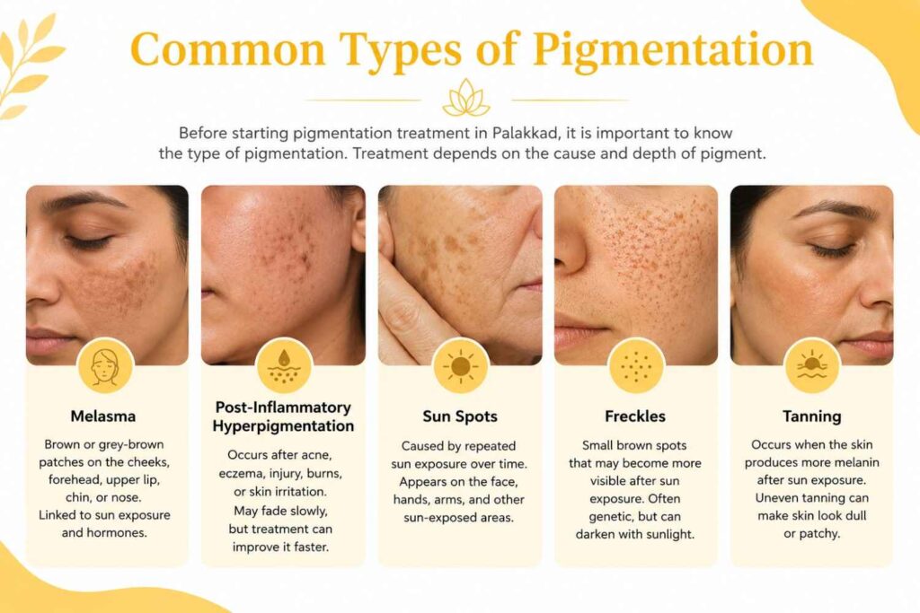Educational infographic explaining common types of skin pigmentation, featuring examples of melasma, post-inflammatory hyperpigmentation, sun spots, freckles, and tanning with brief descriptions of each condition.