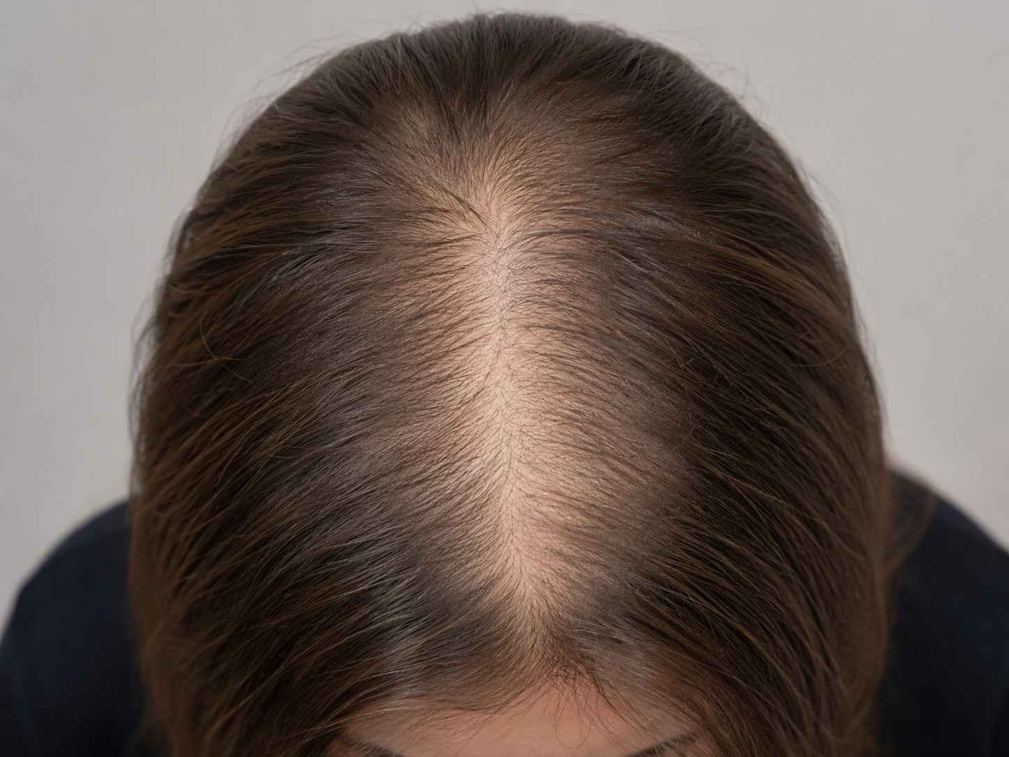 Hair before GFC Treatment, case 1