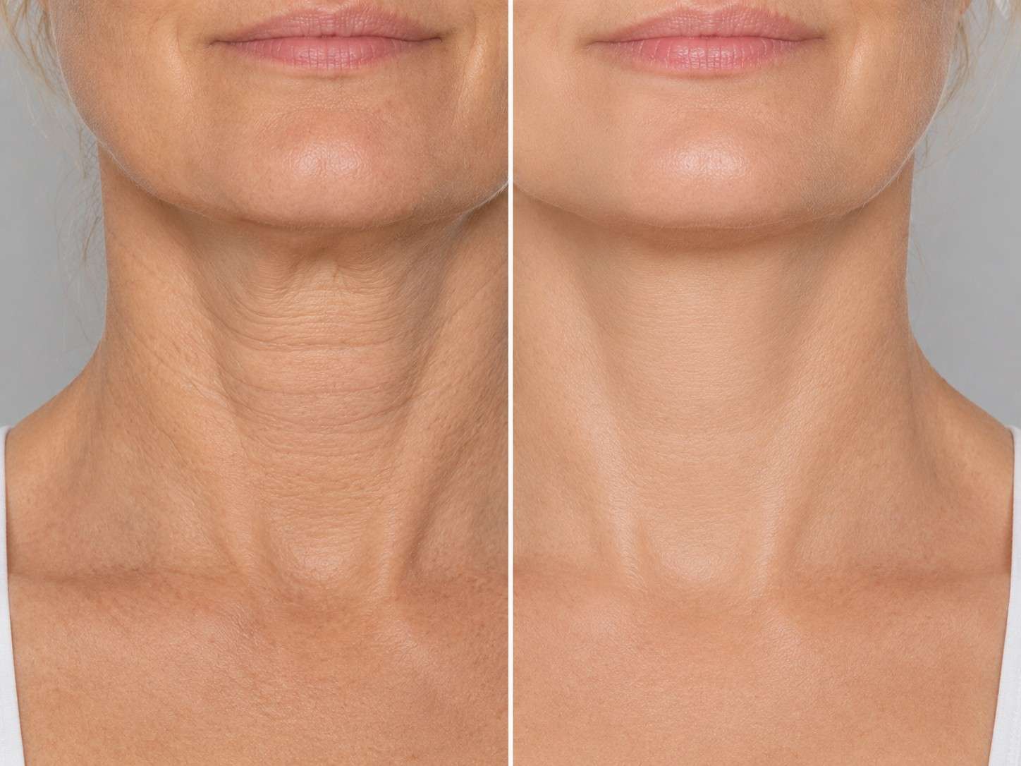 Neck before and after boosting treatment