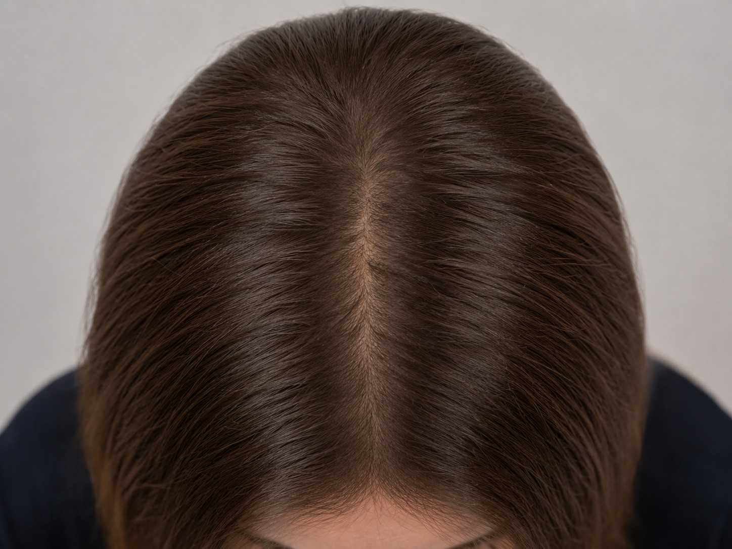 Hair after GFC Treatment, case 1