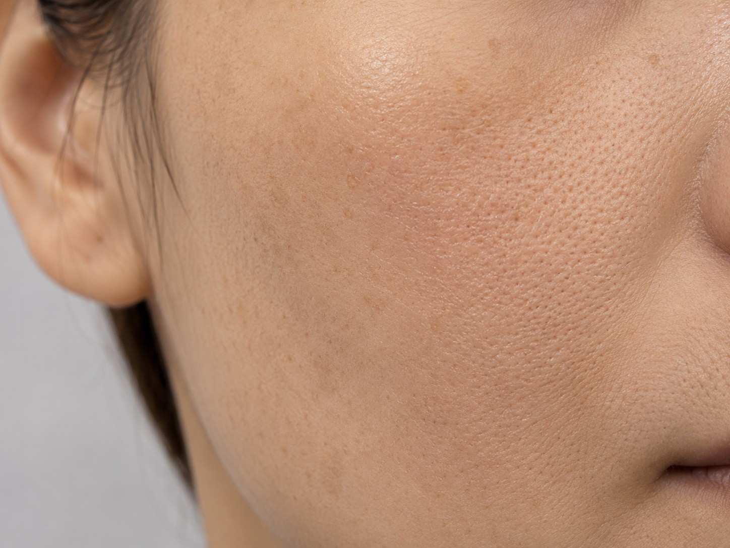 Skin before GFC Treatment, case 1