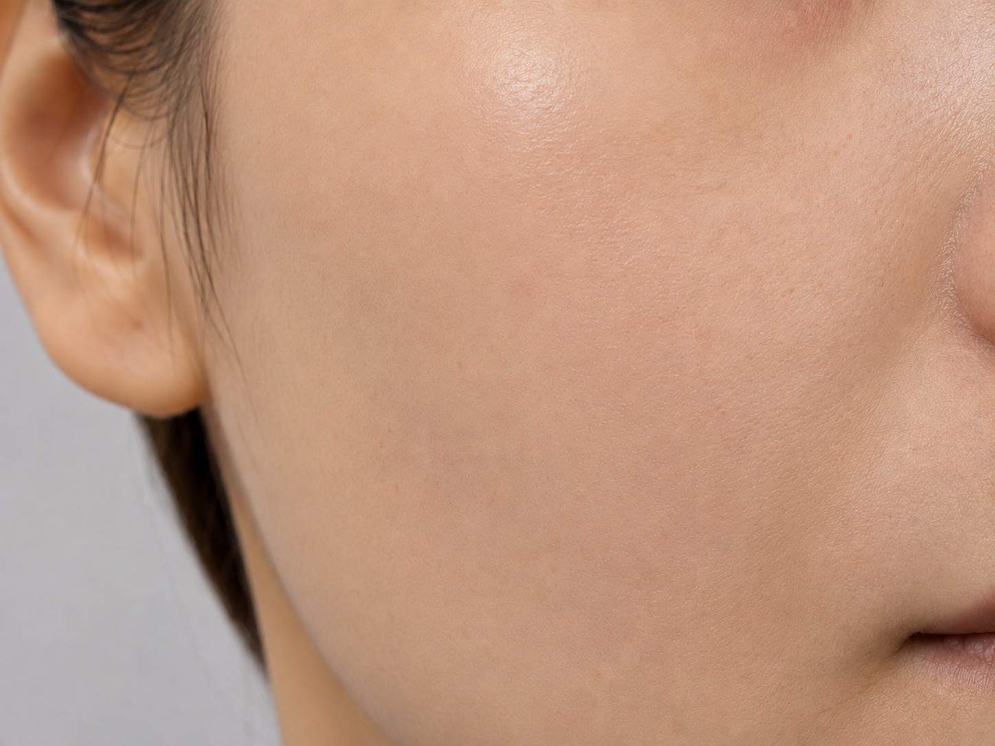 Skin after GFC Treatment, case 1