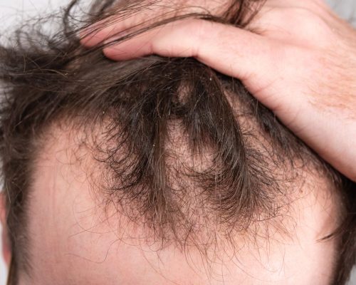 220201173956-01-male-pattern-baldness-stock 220201173956-01-male-pattern-baldness-stock