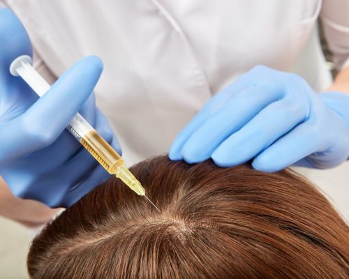wellnesshair-restoration-prp-what-are-the-side-effects-of-a-prp-injection